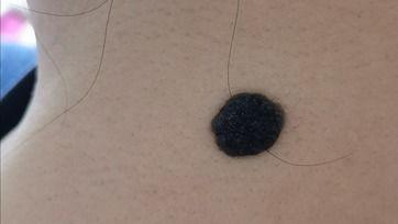 网红黑痣,独特魅力背后的故事