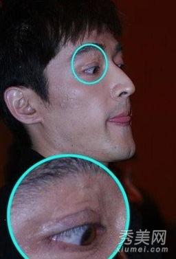 明星 脸上疤痕,勇敢面对挑战的美丽印记